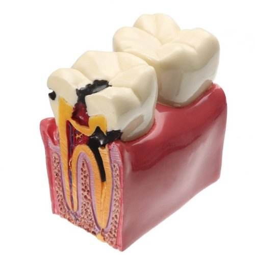 Extensive Caries Comparison Model (Large)