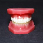 Orthodontic Model (After treatment)