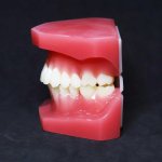 Orthodontic Model (After treatment)