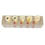 Dental Pulpal Disease Clinical Model