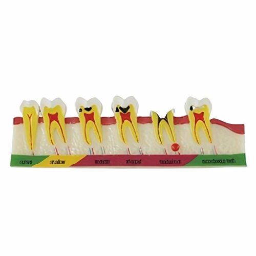 Pulpal and Periapical Pathology Model