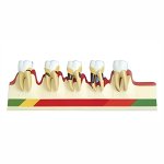 Periodontal Disease Progression Model – Health to Advanced Stage