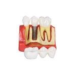 Implant Supported Bridge Model for Prosthetic Restoration