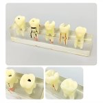 Root Canal Treatment Model