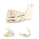 Fractured Mandible Fixation Model with Titanium Plates