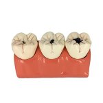 4X Enlarged Caries Developing Model