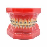 Orthodontic Model – Metal Brackets