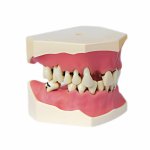 Periodontal Disease Model